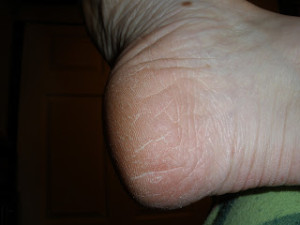 foot after
